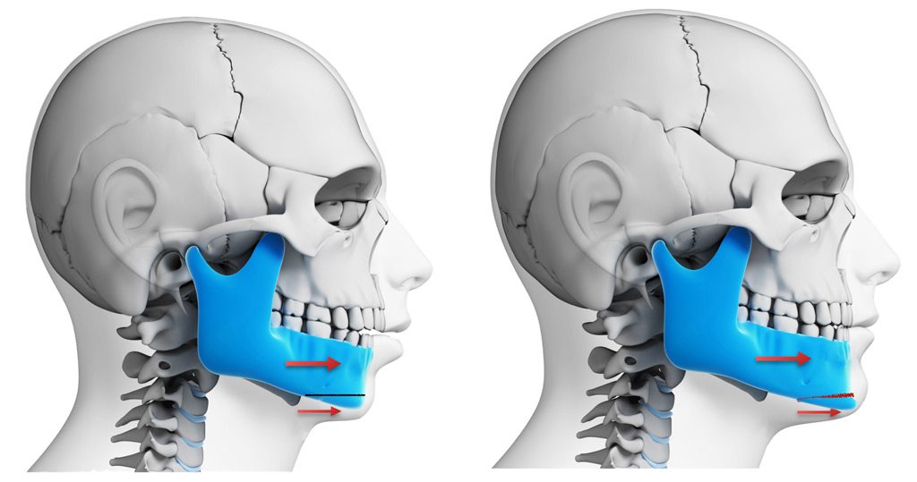 corrective jaw surgery