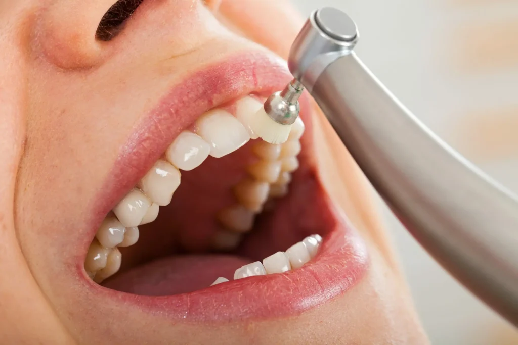 Teeth Cleaning